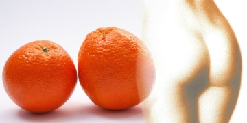 Piel de naranja y celulitis. No basta con perder peso