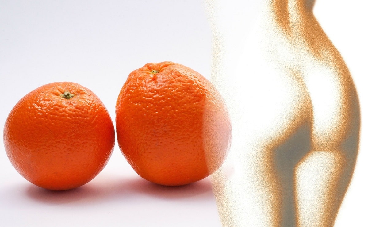 Piel de naranja y celulitis. No basta con perder peso